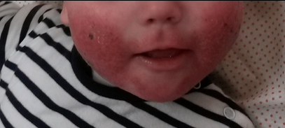 Atopinio dermatito paveikta vaiko oda