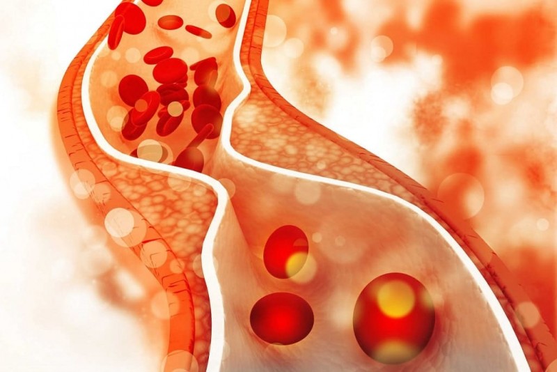 Aterosklerozinės plokštelės kraujagyslėse dėl cholesterolio - medcentras.lt